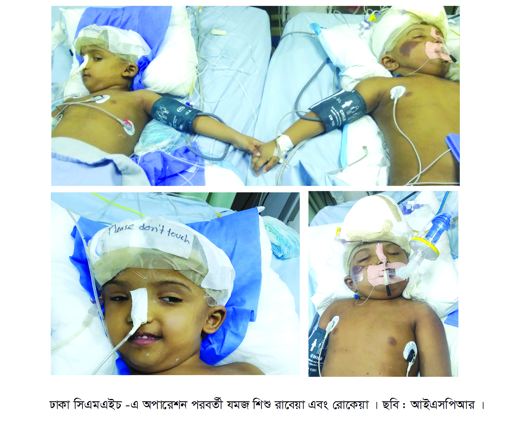 ঢাকা সিএমএইচ-এ জমজ মাথা বাচ্চা রাবেয়া ও রোকেয়ার অপারেশন সাফল্যের সাথে সম্পন্ন পরবর্তী সাংবাদিক সম্মেলন অনুষ্ঠিত